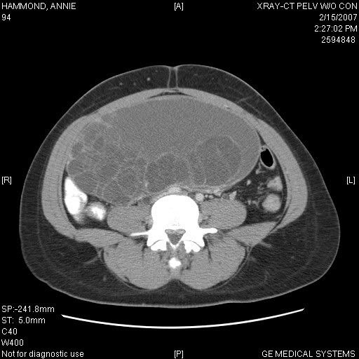 Hot Compress Cyst